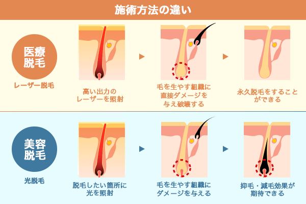 施術方法の違い