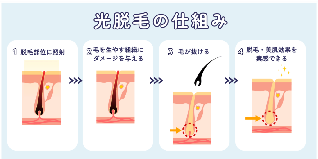 光脱毛の仕組み