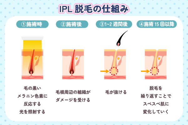 IPL脱毛の仕組み