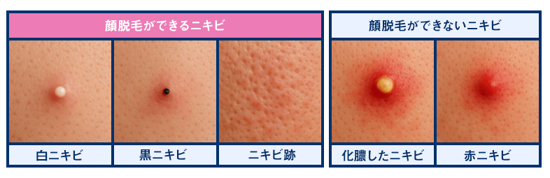 脱毛できるニキビの種類