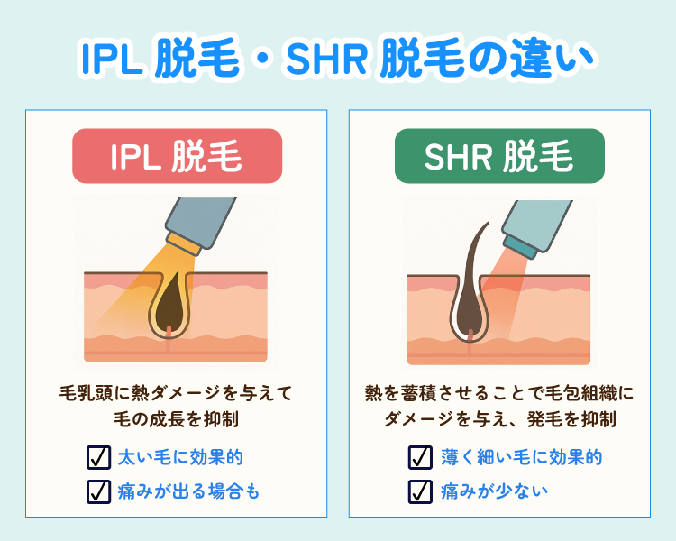 IPL脱毛とSHR脱毛の違い