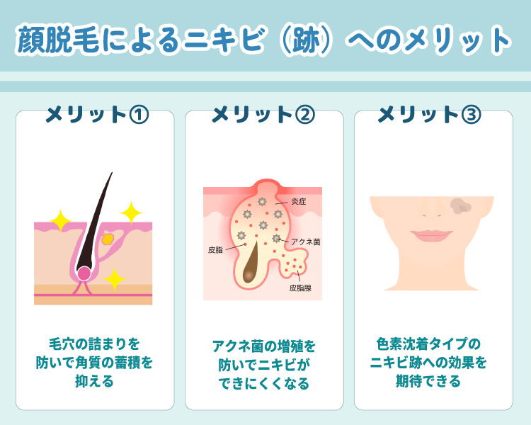 顔脱毛によるニキビ・ニキビ跡へのメリット