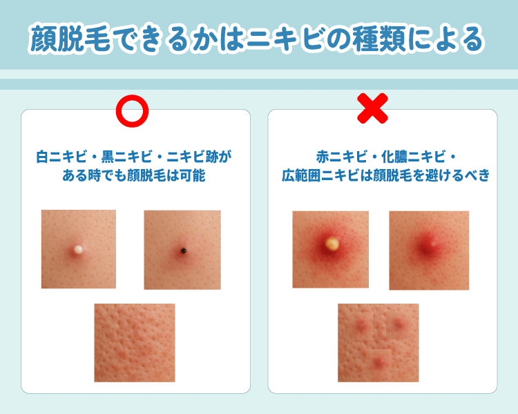 ニキビがある時に顔脱毛はできる?