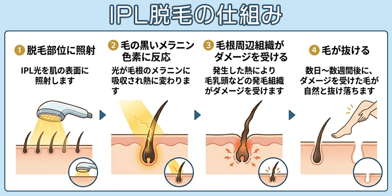 IPL脱毛の仕組み