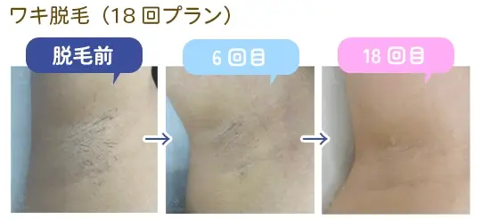 ワキ脱毛の症例画像