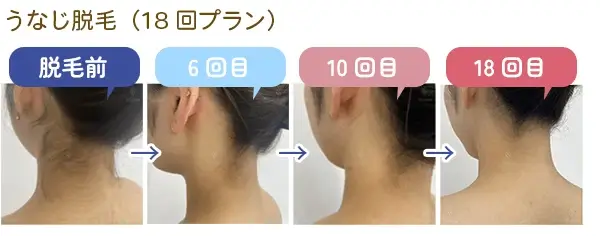 うなじ脱毛の症例画像